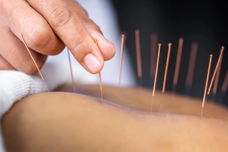 Acupuncture in New Jersey